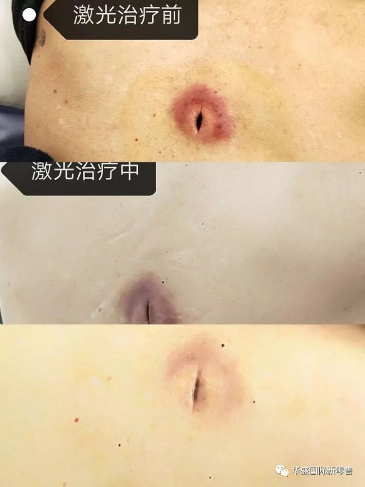 激光治疗仪能治什么病激光治疗仪案例整理【外伤，疼痛，皮肤疾病】_https://www.jmylbn.com_新闻资讯_第12张