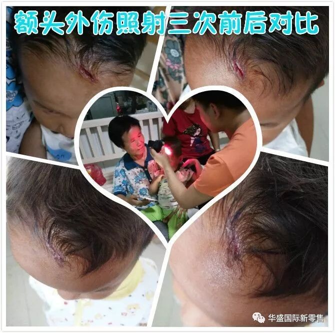 激光治疗仪能治什么病激光治疗仪案例整理【外伤，疼痛，皮肤疾病】_https://www.jmylbn.com_新闻资讯_第37张