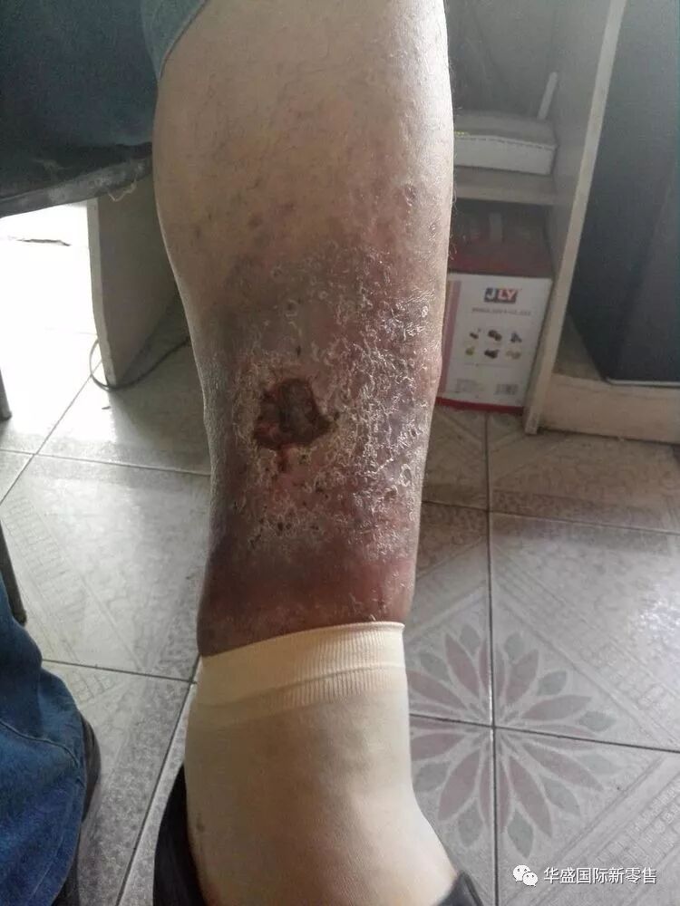 激光治疗仪能治什么病激光治疗仪案例整理【外伤，疼痛，皮肤疾病】_https://www.jmylbn.com_新闻资讯_第25张