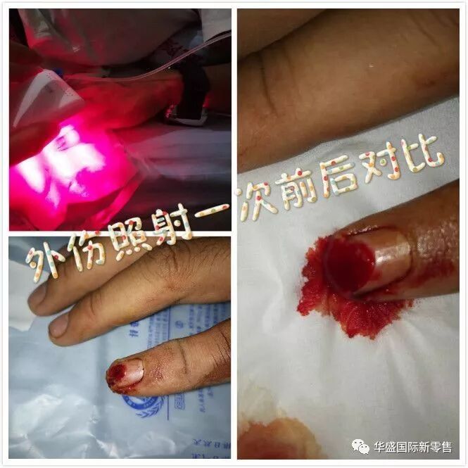 激光治疗仪能治什么病激光治疗仪案例整理【外伤，疼痛，皮肤疾病】_https://www.jmylbn.com_新闻资讯_第36张