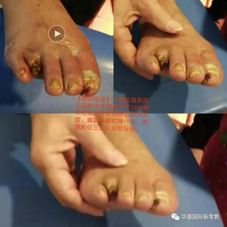 激光治疗仪能治什么病激光治疗仪案例整理【外伤，疼痛，皮肤疾病】_https://www.jmylbn.com_新闻资讯_第39张