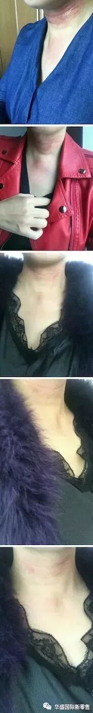 激光治疗仪能治什么病激光治疗仪案例整理【外伤，疼痛，皮肤疾病】_https://www.jmylbn.com_新闻资讯_第42张