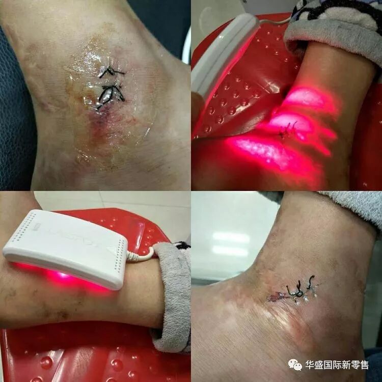 激光治疗仪能治什么病激光治疗仪案例整理【外伤，疼痛，皮肤疾病】_https://www.jmylbn.com_新闻资讯_第10张