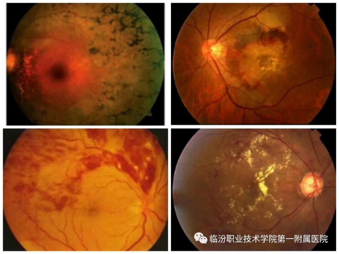 眼底照相机怎么相机照一照，眼底健康全知道_https://www.jmylbn.com_新闻资讯_第4张