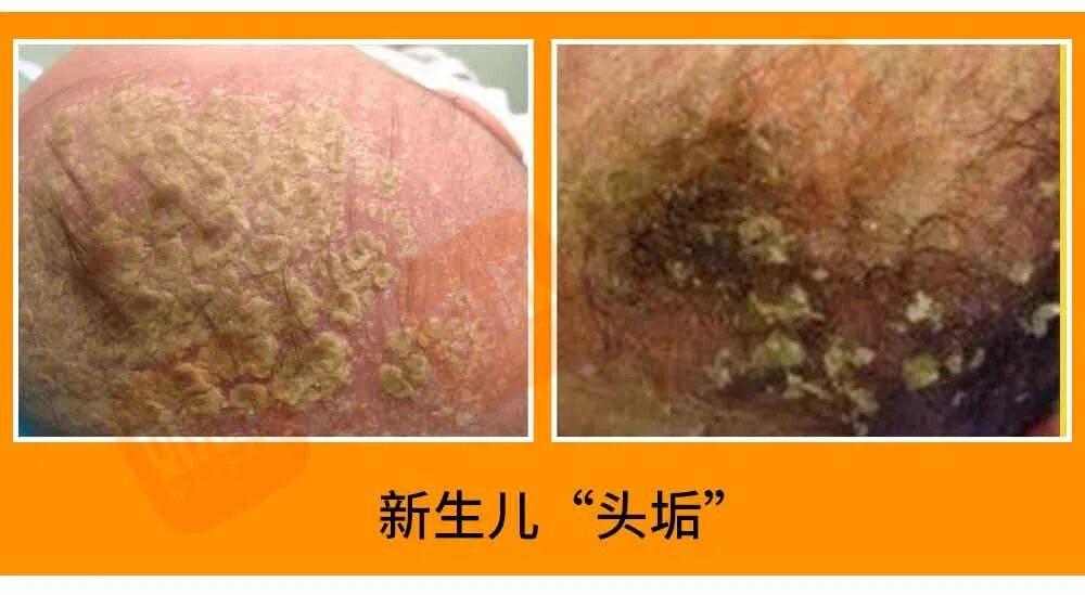 这个地方太爱干净，反而害了娃！清理乳痂，这样做更好 - 脉脉
