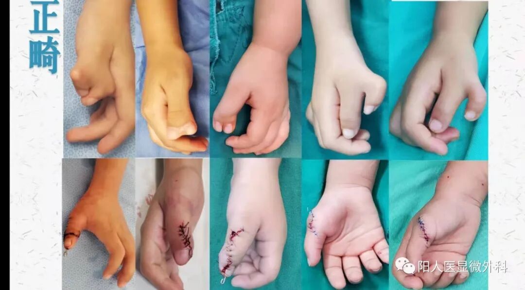 怎么区分显微剪刀天生剪刀手️——显微外科带你了解什么是多指畸形_https://www.jmylbn.com_新闻资讯_第36张