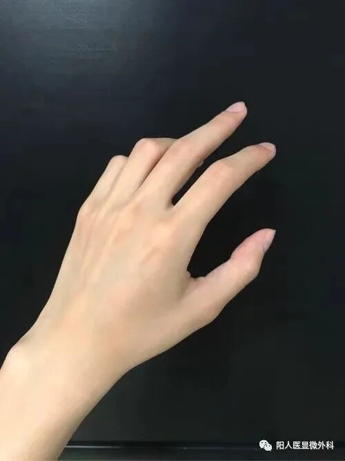怎么区分显微剪刀天生剪刀手️——显微外科带你了解什么是多指畸形_https://www.jmylbn.com_新闻资讯_第31张