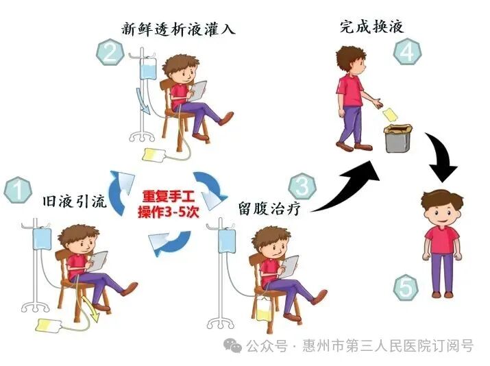 持续非卧床腹膜透析