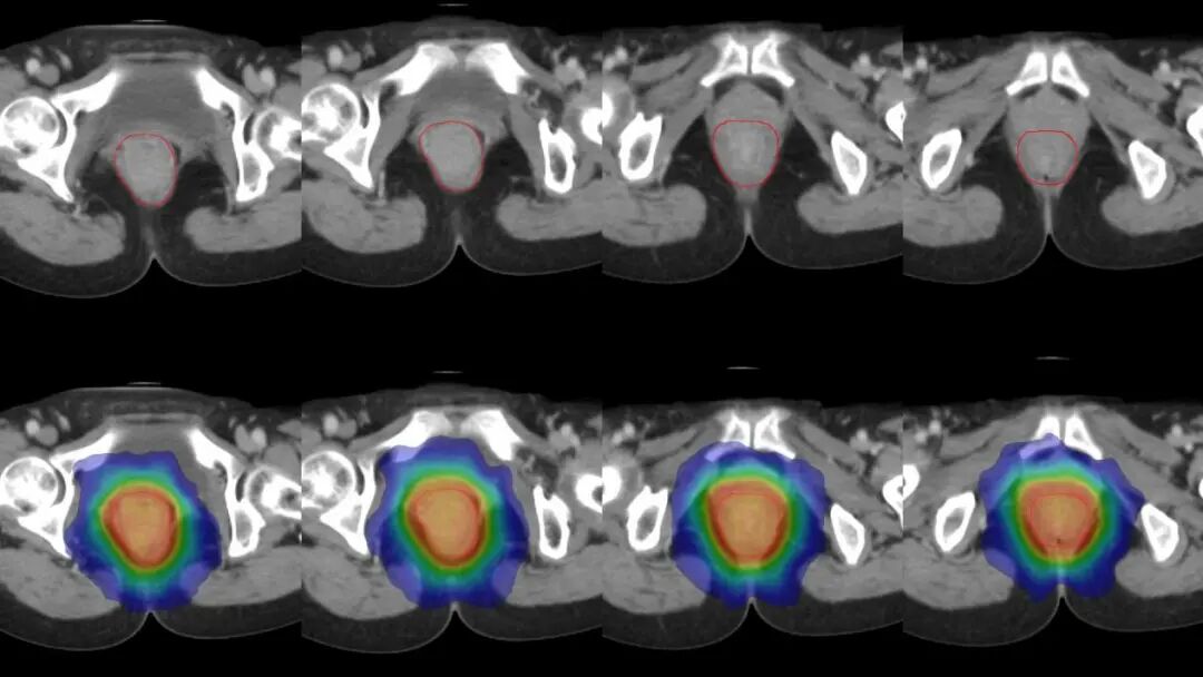 图注：上图红线为根据磁共振勾画的肿瘤靶区。下图为放射剂量分布，可见射线分布集中于肿瘤病灶，中心区高剂量照射，周边剂量快速跌落，形成锐利的集束聚焦照射，周围组织得到良好保护。