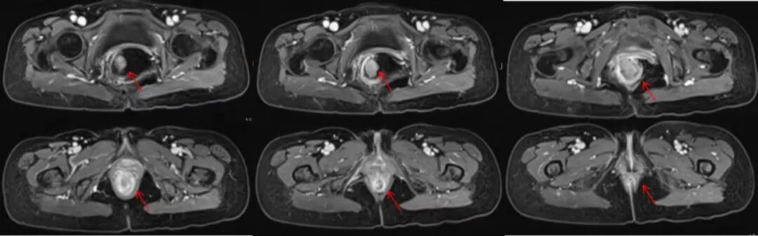 图注：盆腔MRI可见直肠腔内及肛缘附近软组织肿物，病灶明显强化；肿物根部位于肛缘旁，凸向直肠内，造成肠内积气。
