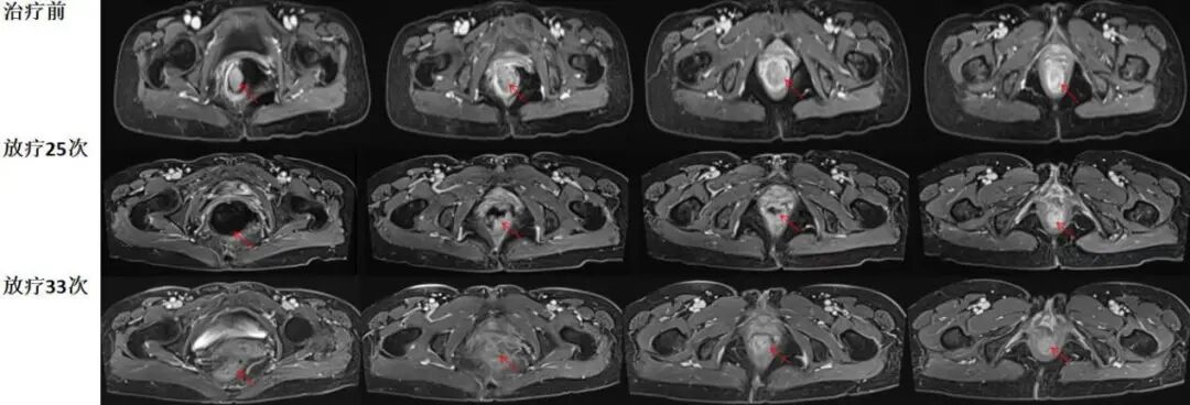 图注：放疗25次/5周复查可见，直肠内肿物显著缩退，直肠内仍有积气。治疗结束后复查可见，肿瘤病灶完全缩退，没有明显残留强化肿物，直肠内积气消失。