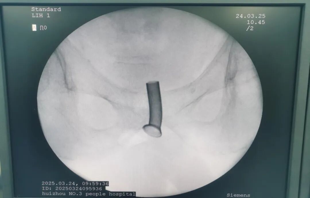 尿道支架植入体内后X光示意图