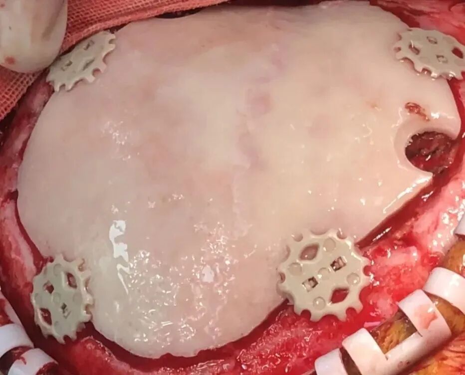 自体骨回植修补