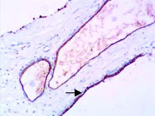 胰腺漿液性微囊性腺瘤的新認識 健康 第5張