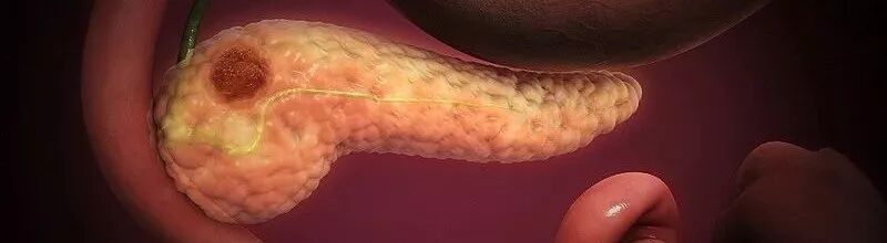 胰腺癌新辅助治疗的现状与展望