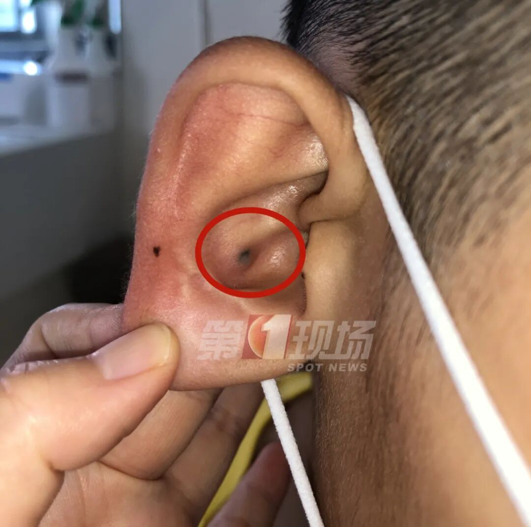 【提醒】9岁娃耳朵长出小疙瘩,逐渐变黑...起因竟是半年前在学校发生