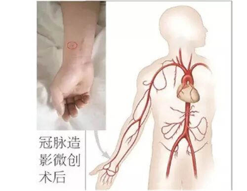 彩超logiq怎么读气短胸闷！光做心电图就够了吗？彩超、造影了解一下！_https://www.jmylbn.com_新闻资讯_第9张