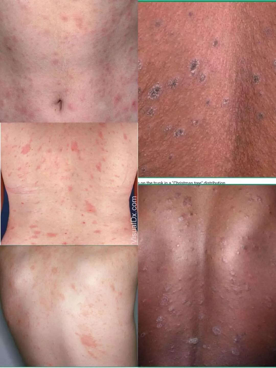 从文献聊：高压氧应积极应用到玫瑰糠疹治疗中