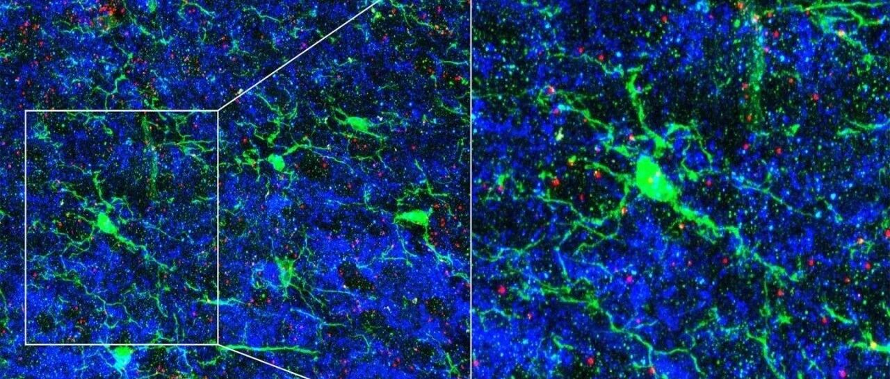 帕金森病原来不是一种病，而是两种病