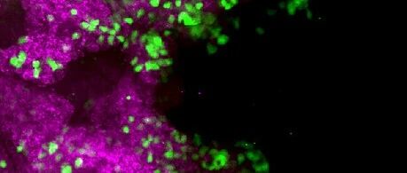 《Cell》过量脂肪有助于癌细胞抑制免疫细胞，并加速肿瘤生长