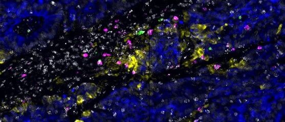 《Immunity》又一反转发现：乳酸菌破坏免疫抑制，并刺激肿瘤生长
