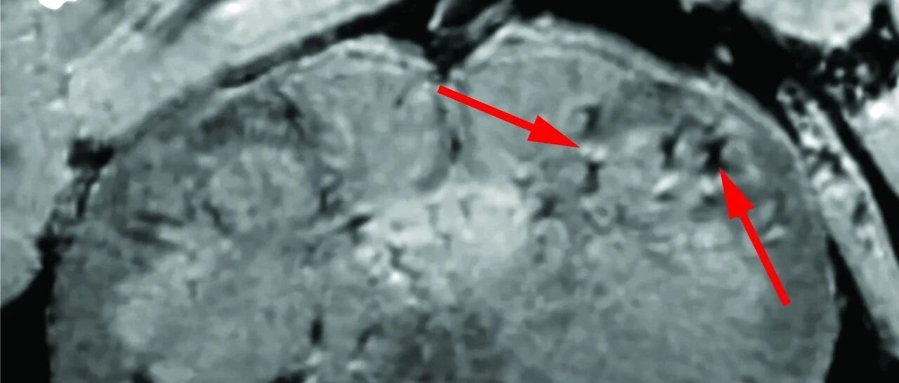 NEJM：COVID-19患者大脑中出现血管损伤