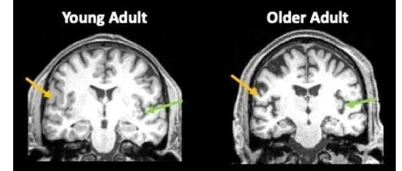 《Nature》轻症COVID-19也会造成脑容量减少，相当于提前衰老