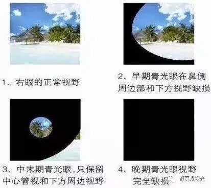 眼科病常见症状 视觉障碍之视野缺损 舒亮眼视光 微信公众号文章阅读 Wemp