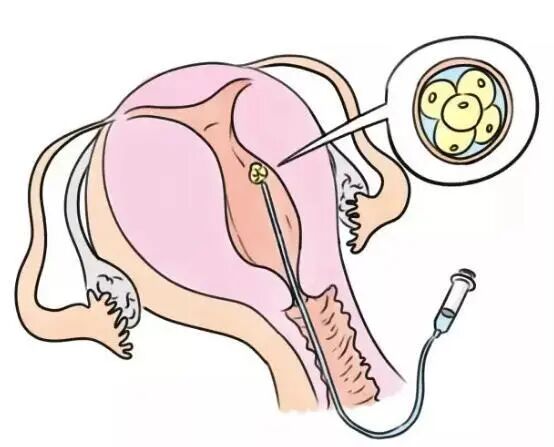 这就是你想要的优胚 明明白白胚胎质量评分 蒲荷孕育 微信公众号文章阅读 Wemp