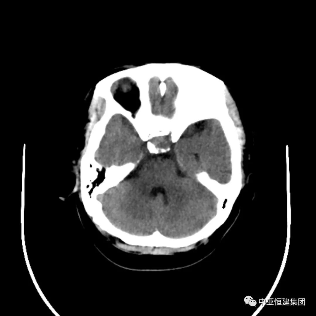 为什么脑垂体瘤要做MRI（核磁共振）检查