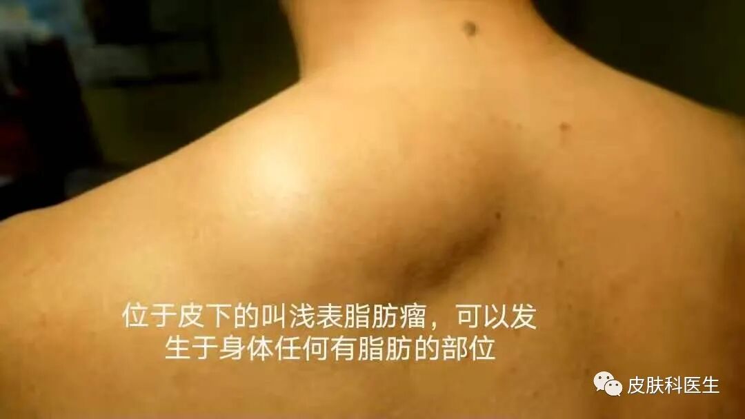 脂肪瘤是什么瘤