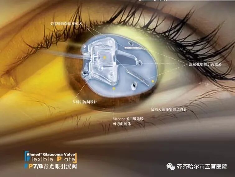 怎么装青光眼【健康讲堂】齐齐哈尔市五官医院眼科专家徐文双：眼睛里装“阀门”，摆脱难治性青光眼困扰!_https://www.jmylbn.com_新闻资讯_第8张