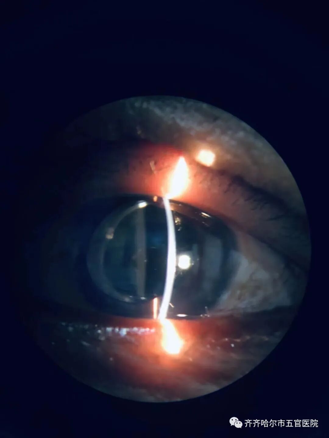 怎么装青光眼【健康讲堂】齐齐哈尔市五官医院眼科专家徐文双：眼睛里装“阀门”，摆脱难治性青光眼困扰!_https://www.jmylbn.com_新闻资讯_第11张