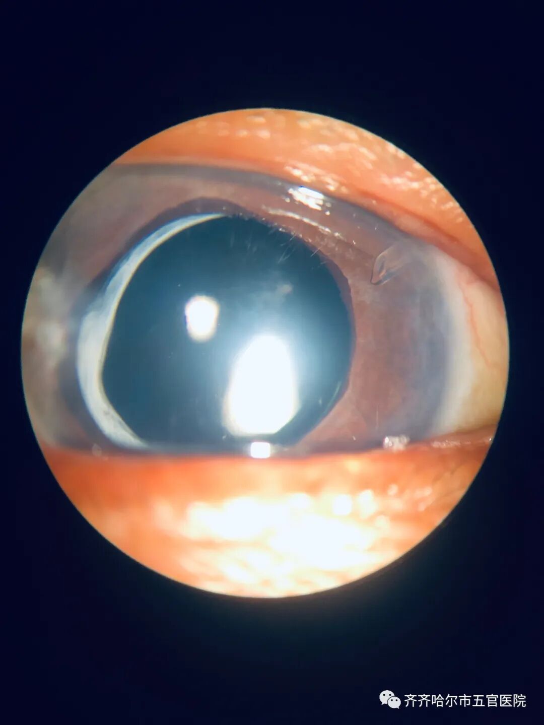 怎么装青光眼【健康讲堂】齐齐哈尔市五官医院眼科专家徐文双：眼睛里装“阀门”，摆脱难治性青光眼困扰!_https://www.jmylbn.com_新闻资讯_第10张