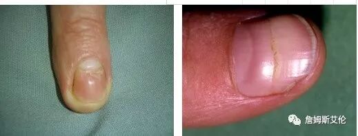 聊聊休止期脱发和雄性脱发