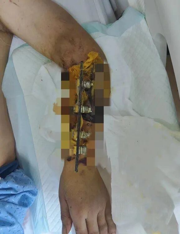 妙手保肢丨青大附院手足显微外科争分夺秒为伤者接回断臂