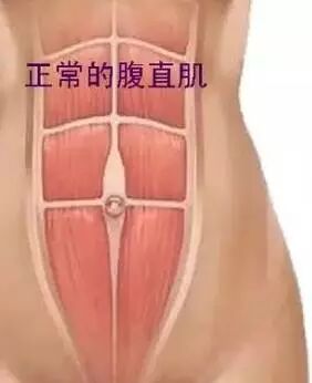 一直在锻炼，腹直肌分离为什么恢复不好呢？