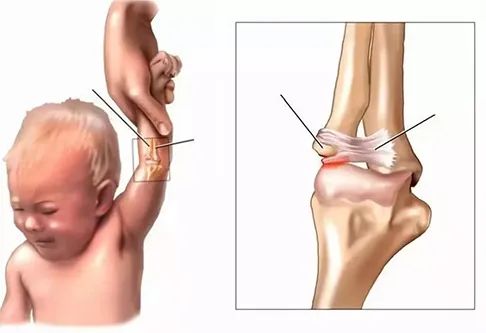 孩子胳膊脱臼好几次了,到底是怎么回事?