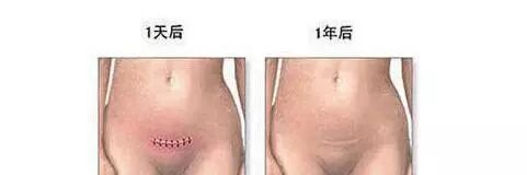 剖腹產要挨幾刀？縫多少層肚皮？說母愛偉大是有原因的！ 親子 第2張