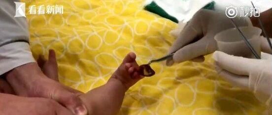 出生1天的新生儿险被截肢！！原因竟是妈妈...