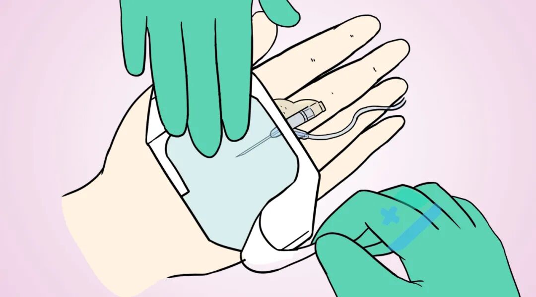 留置针怎么贴膜留置针贴膜总脱落，怎么办？注意这几点轻松避免！_https://www.jmylbn.com_新闻资讯_第9张