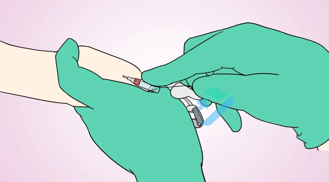 留置针都有哪些厂家80%的护士都不知道：静脉留置输液竟有这么多问题？_https://www.jmylbn.com_新闻资讯_第5张