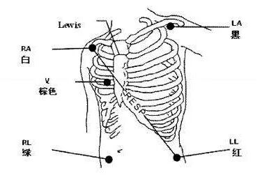 心电监护仪怎么看图解关于心电监护，这些知识你确定都掌握了吗？_https://www.jmylbn.com_新闻资讯_第5张