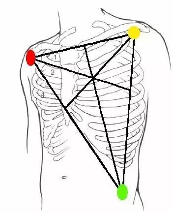 心电监护仪怎么看图解关于心电监护，这些知识你确定都掌握了吗？_https://www.jmylbn.com_新闻资讯_第6张