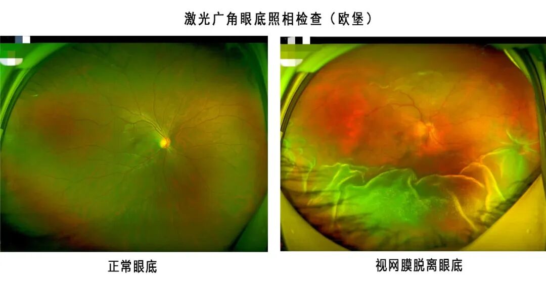 彩色眼底照相查什么眼底一张照，眼病早知道！哪些人的眼睛需要拍照？_https://www.jmylbn.com_新闻资讯_第2张