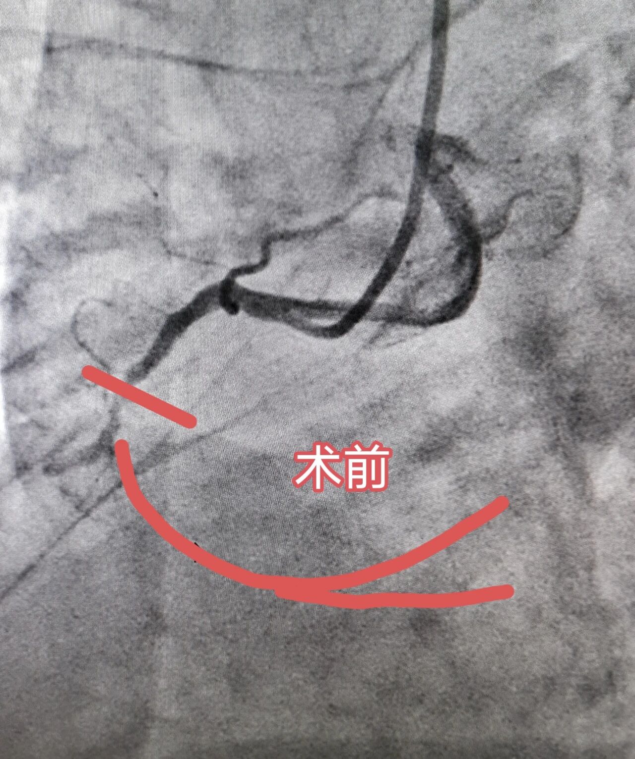 心脏造影多少钱