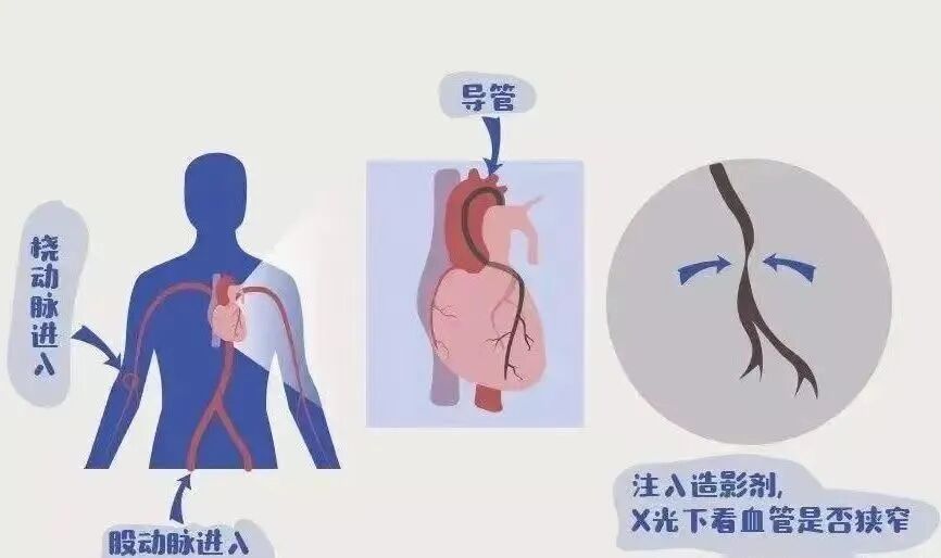 段医生大白话讲清冠脉造影费用与必要性，帮你明智决策是否要做心脏造影检查