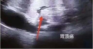 胃造影用的是什么机子胃肠检查的新技术、新突破——胃肠充盈超声造影_https://www.jmylbn.com_新闻资讯_第7张