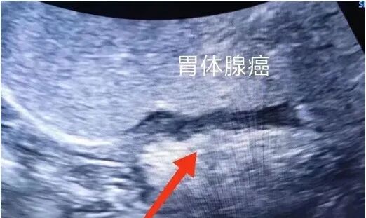 胃造影用的是什么机子胃肠检查的新技术、新突破——胃肠充盈超声造影_https://www.jmylbn.com_新闻资讯_第10张