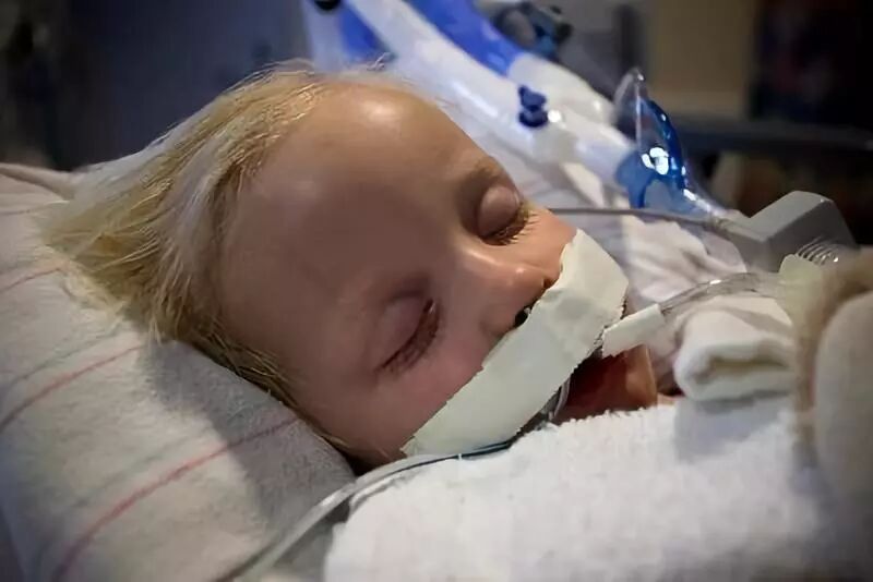 压缩气怎么雾化【专家共识】机械通气时雾化吸入_https://www.jmylbn.com_新闻资讯_第6张